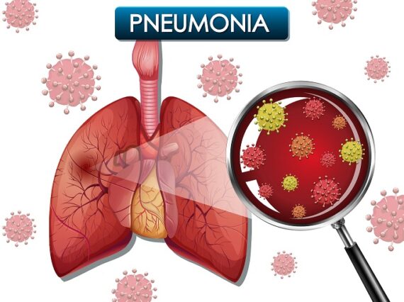 Mycoplasma Pneumoniae cos' è?