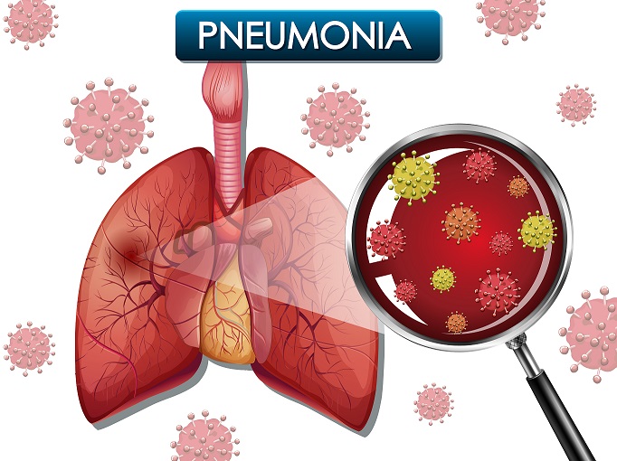 Mycoplasma Pneumoniae cos' è? Scopri il Test Rapido IVY